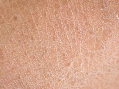 Pele seca no inverno: 7 dicas para uma pele saudável