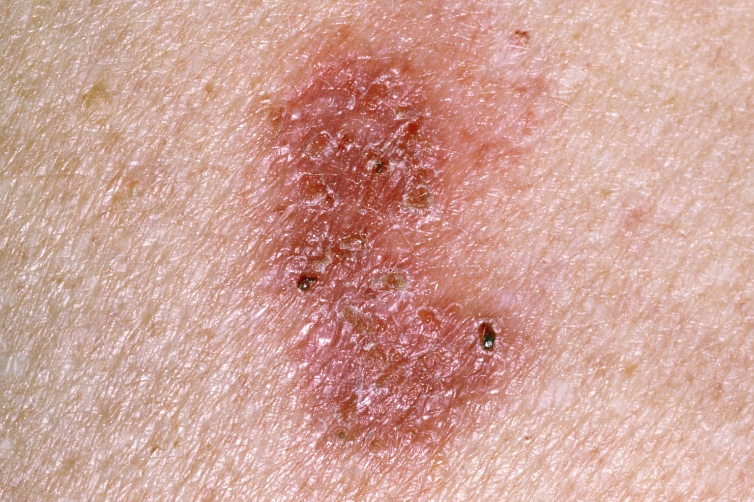 Câncer de pele nÃo-melanoma
