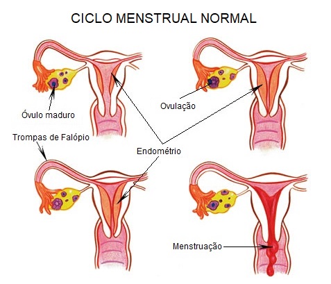 Endometriose: causas, riscos e sintomas