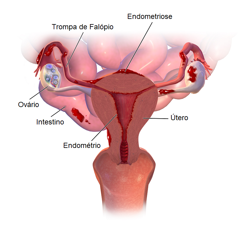 Endometriose: diagnóstico e tratamento