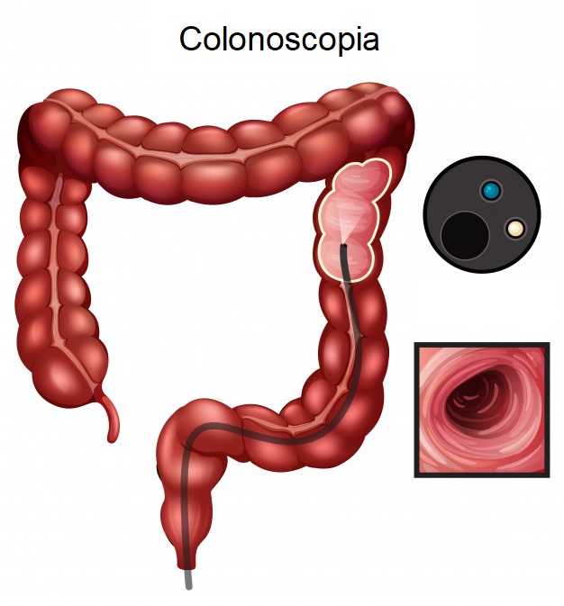 CÂncer de cÓlon (colorretal): sintomas e diagnóstico