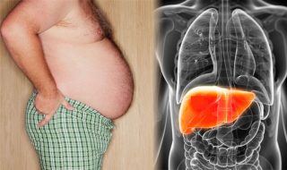 FÍgado gorduroso (esteatose hepática): causas, sintomas e tratamento