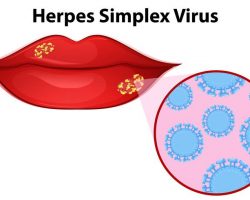 Herpes labial: sintomas e tratamento