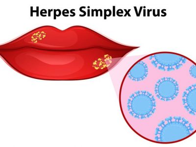 Herpes labial: sintomas e tratamento