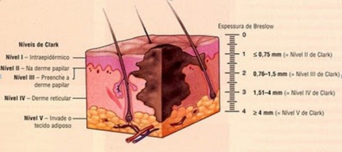 Câncer de pele melanoma: tipos e como identificar