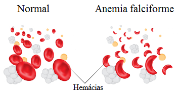 Anemia: conheça as causas e os sintomas