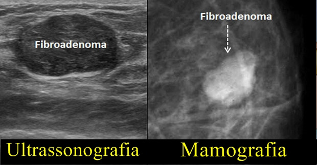 Fibroadenoma e outros tumores benignos da mama