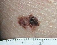 Câncer de pele melanoma: tipos e como identificar